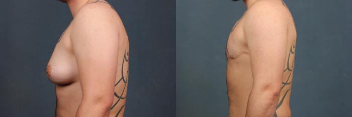 Before & After Top Surgery Case 735 Left Side View in Louisville & Lexington, KY