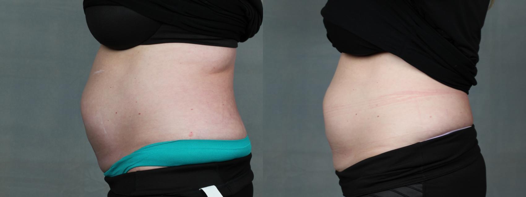 Before & After TruSculpt Case 662 Left Side View in Louisville, KY