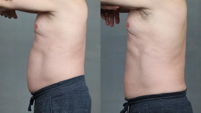 Before & After TruSculpt Case 673 Right Side View in Louisville & Lexington, KY