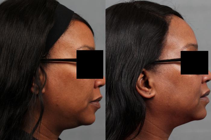 Before & After TruSculpt Case 674 Right Side View in Louisville & Lexington, KY