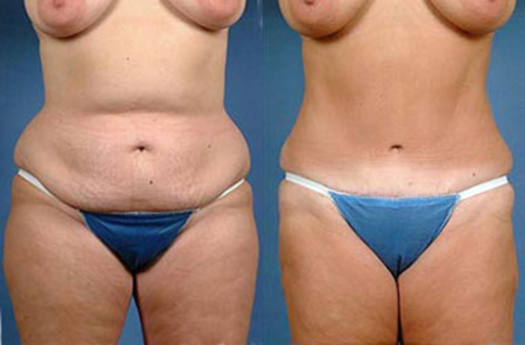 Before & After Tummy Tuck Case 139 View #1 View in Louisville & Lexington, KY