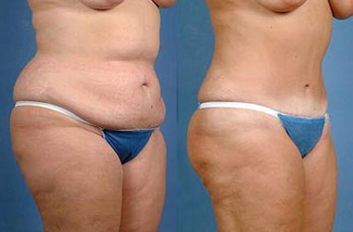Before & After Tummy Tuck Case 139 View #2 View in Louisville & Lexington, KY