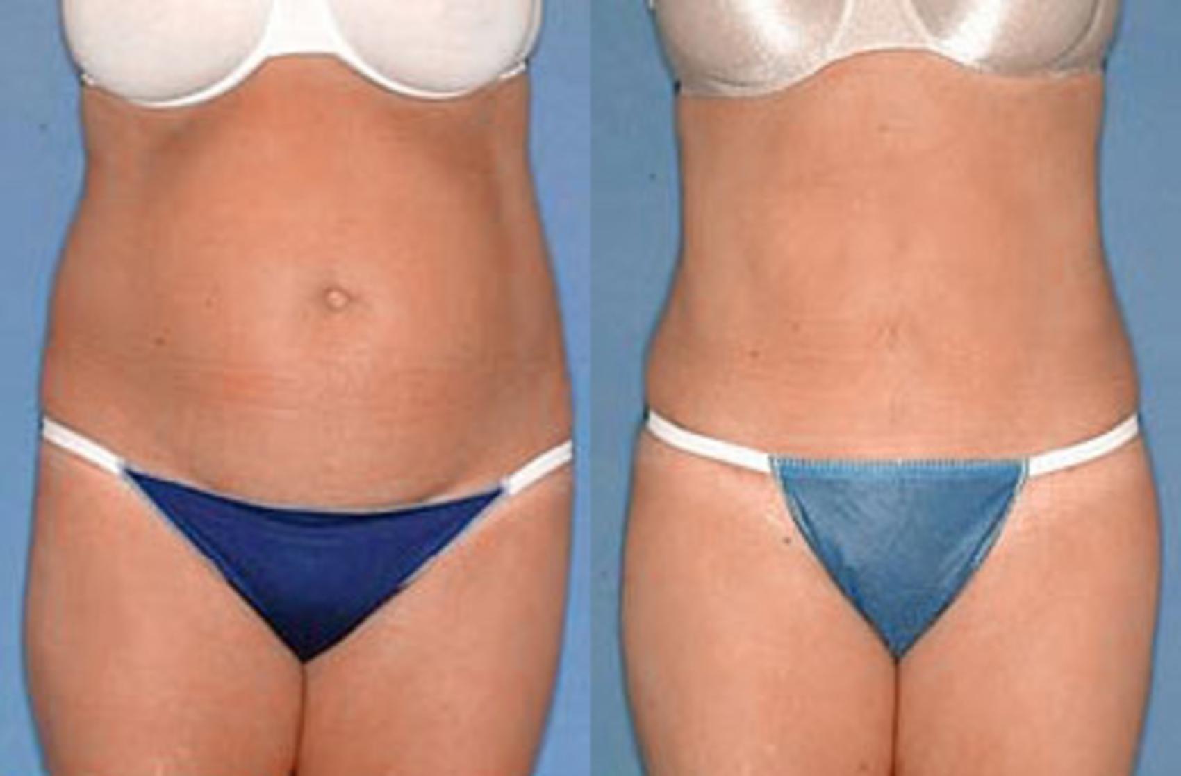 Before & After Tummy Tuck Case 140 View #1 View in Louisville & Lexington, KY