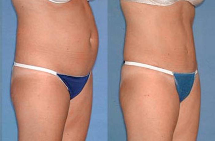 Before & After Tummy Tuck Case 140 View #2 View in Louisville & Lexington, KY