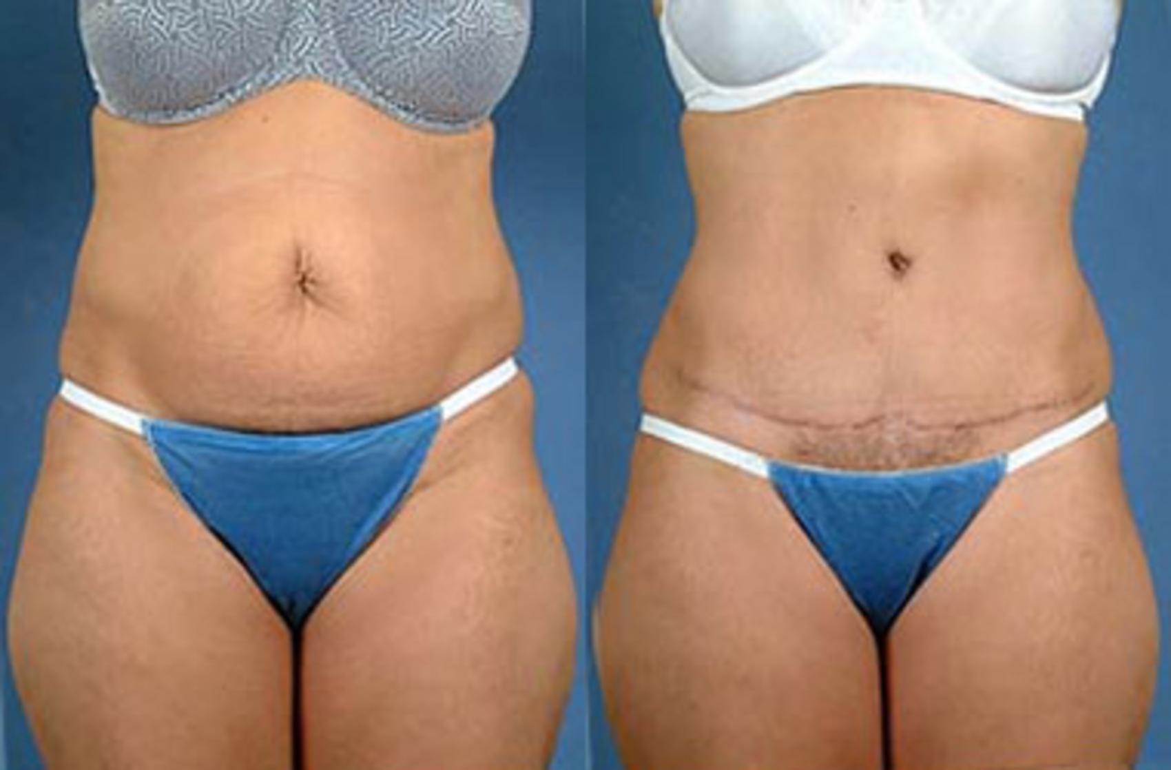 Before & After Tummy Tuck Case 141 View #1 View in Louisville & Lexington, KY