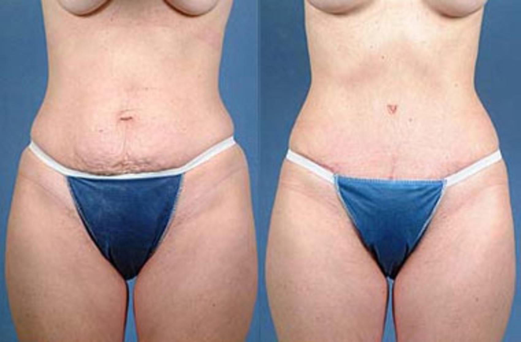 Before & After Tummy Tuck Case 142 View #1 View in Louisville & Lexington, KY