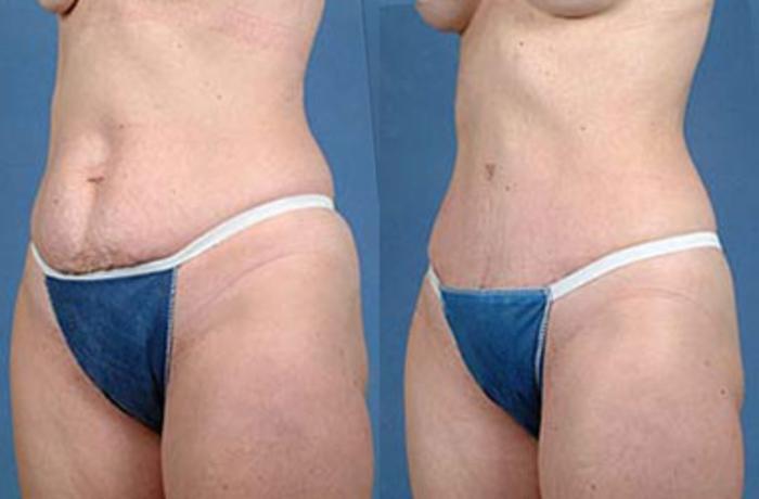 Before & After Tummy Tuck Case 142 View #2 View in Louisville & Lexington, KY