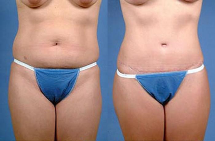 Before & After Tummy Tuck Case 143 View #1 View in Louisville & Lexington, KY
