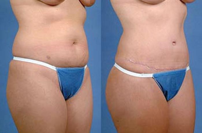 Before & After Tummy Tuck Case 143 View #2 View in Louisville & Lexington, KY
