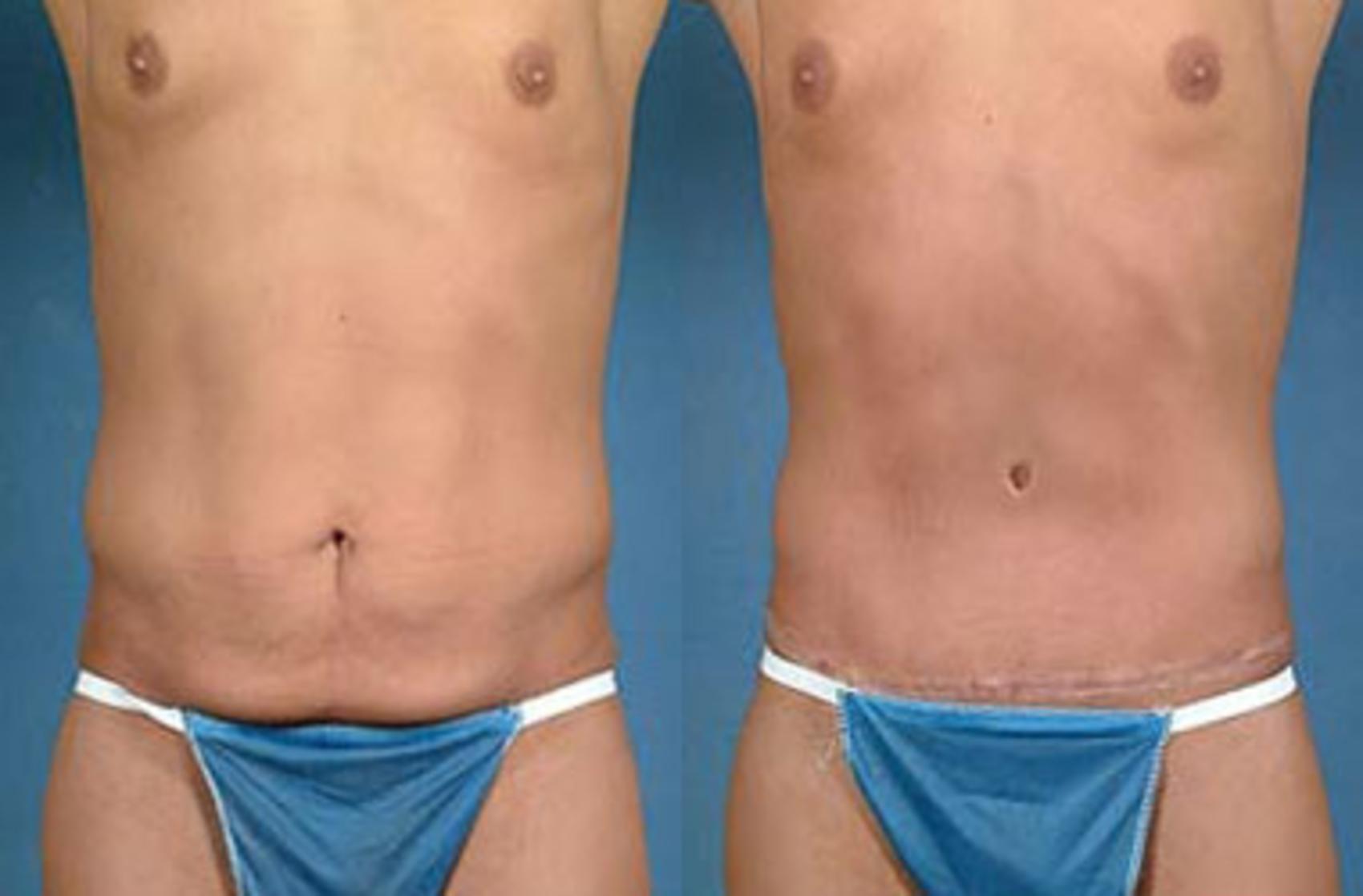 Before & After Tummy Tuck Case 144 View #1 View in Louisville & Lexington, KY