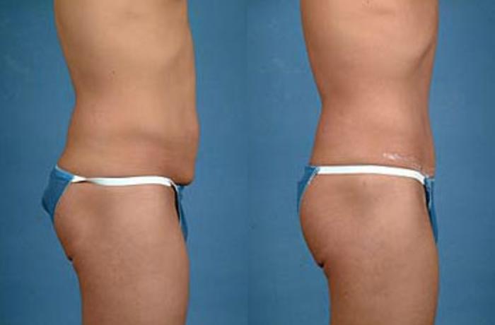 Before & After Tummy Tuck Case 144 View #2 View in Louisville & Lexington, KY