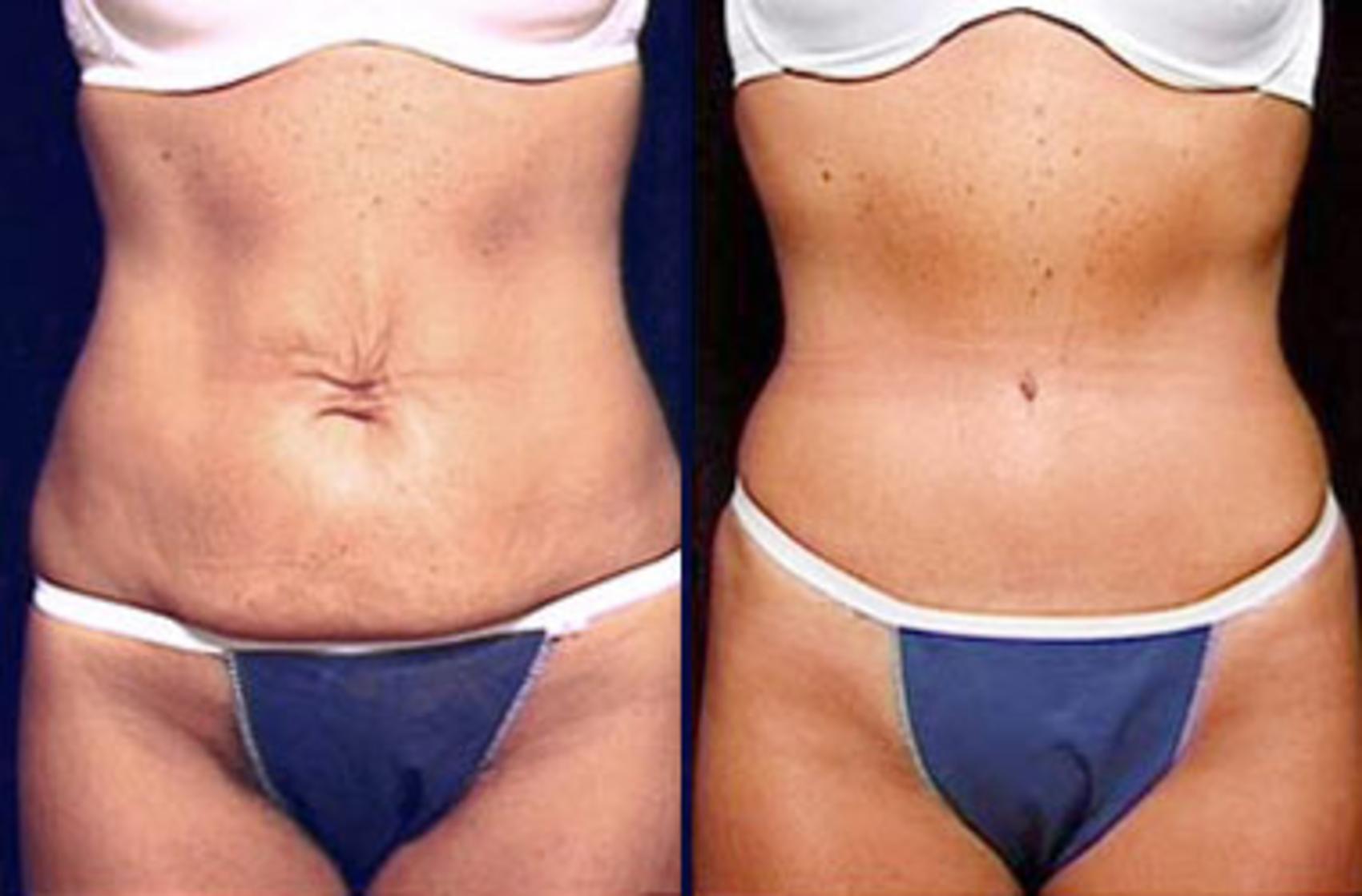 Before & After Tummy Tuck Case 146 View #1 View in Louisville & Lexington, KY