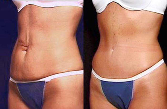 Before & After Tummy Tuck Case 146 View #2 View in Louisville & Lexington, KY