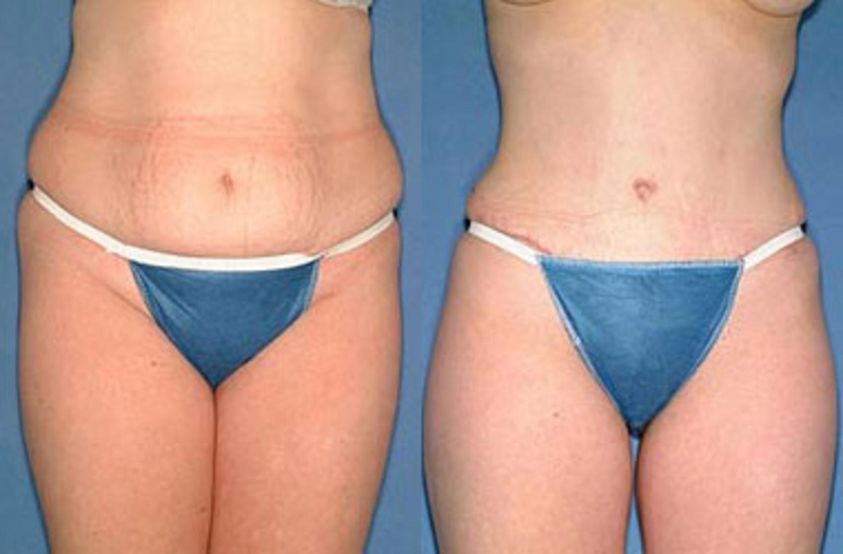 Before & After Tummy Tuck Case 147 View #1 View in Louisville & Lexington, KY