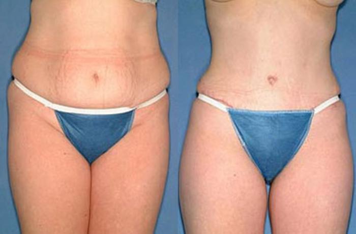 Before & After Tummy Tuck Case 147 View #1 View in Louisville, KY