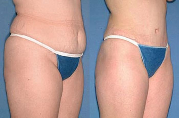 Before & After Tummy Tuck Case 147 View #2 View in Louisville & Lexington, KY