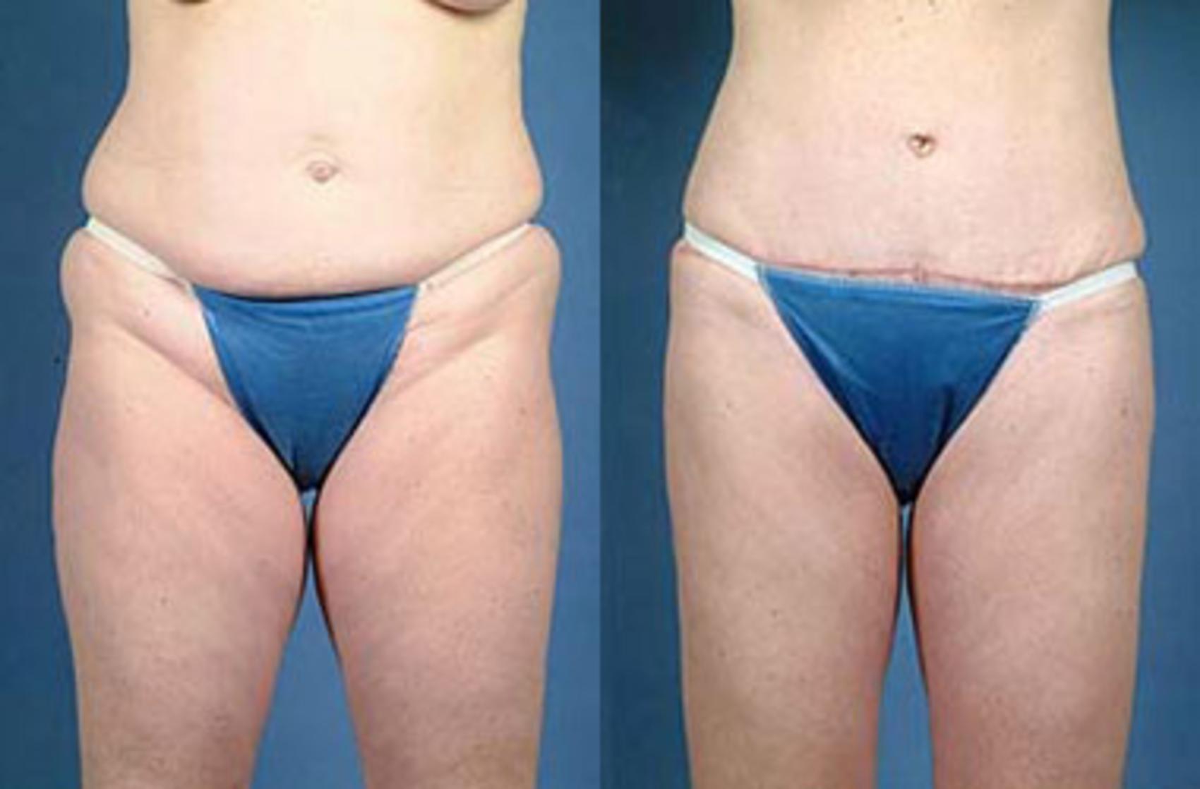 Tummy Tuck Case 148 Before & After View #1 | Louisville, KY | CaloSpa® Rejuvenation Center