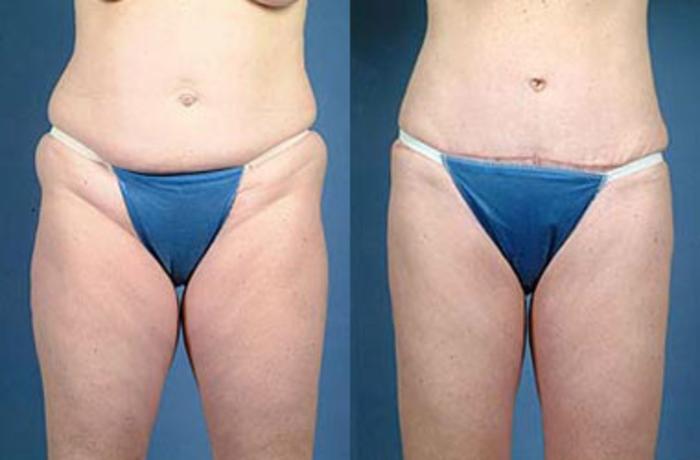 Tummy Tuck Case 148 Before & After View #1 | Louisville, KY | CaloSpa® Rejuvenation Center