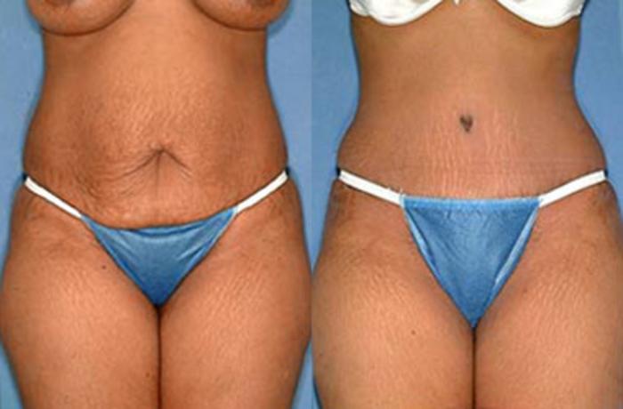 Tummy Tuck Case 150 Before & After View #1 | Louisville, KY | CaloSpa® Rejuvenation Center