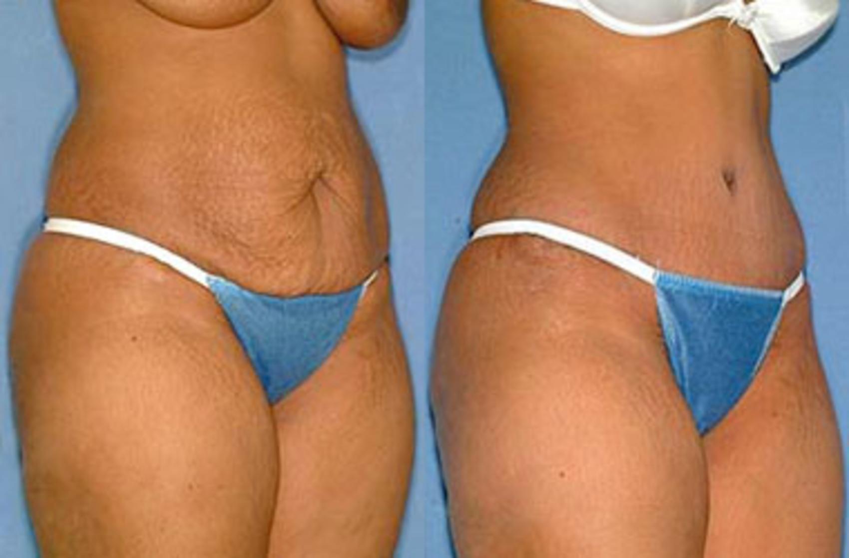 Before & After Tummy Tuck Case 150 View #2 View in Louisville & Lexington, KY
