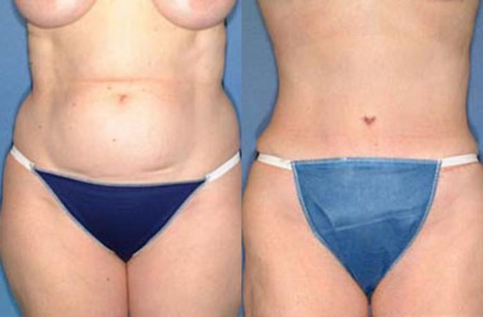 Before & After Tummy Tuck Case 151 View #1 View in Louisville & Lexington, KY