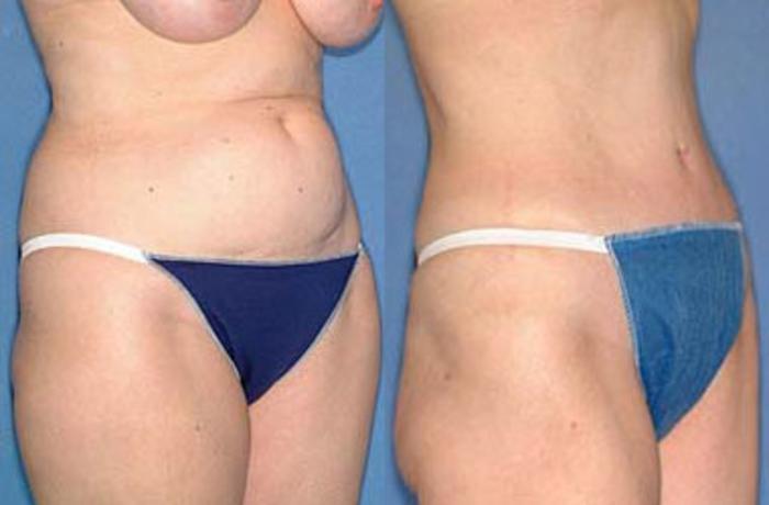 Tummy Tuck Case 151 Before & After View #2 | Louisville, KY | CaloSpa® Rejuvenation Center