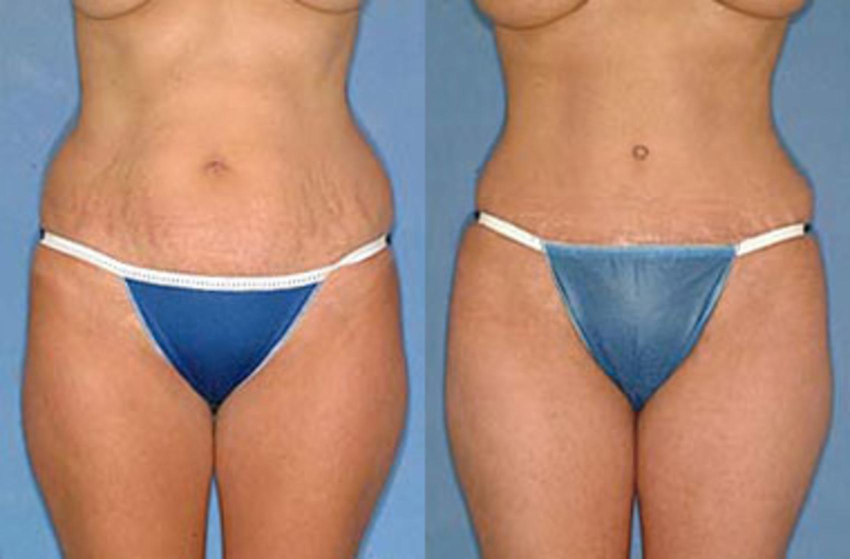 Before & After Tummy Tuck Case 152 View #1 View in Louisville & Lexington, KY