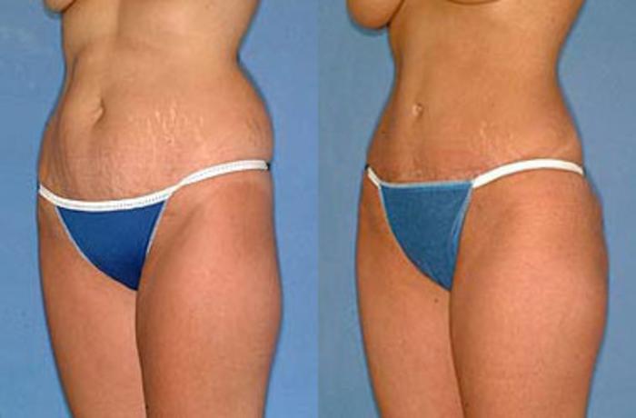 Before & After Tummy Tuck Case 152 View #2 View in Louisville & Lexington, KY