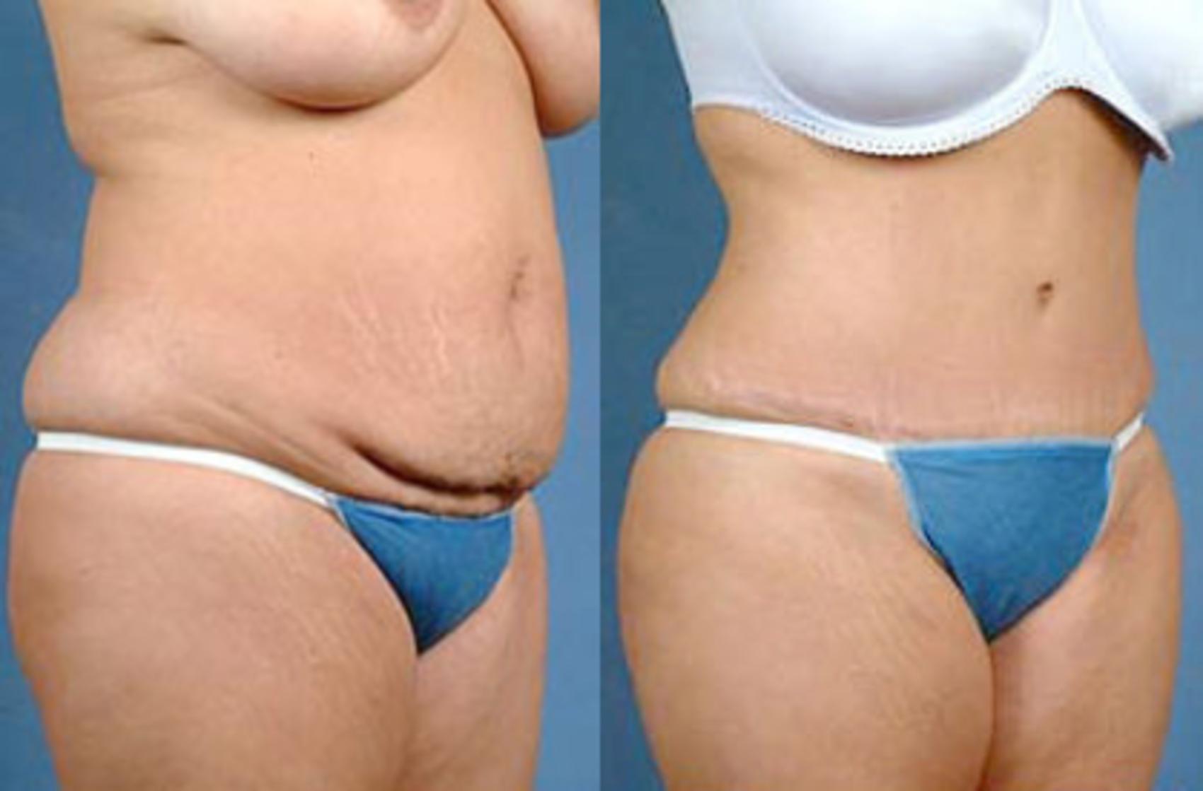 Before & After Tummy Tuck Case 153 View #2 View in Louisville & Lexington, KY
