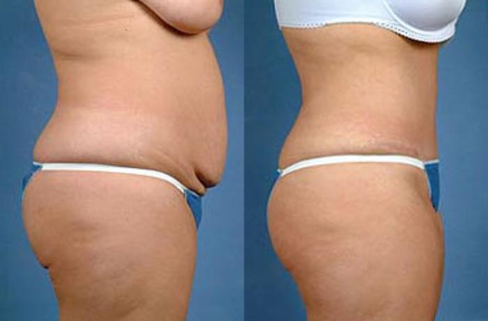 Before & After Tummy Tuck Case 153 View #3 View in Louisville & Lexington, KY