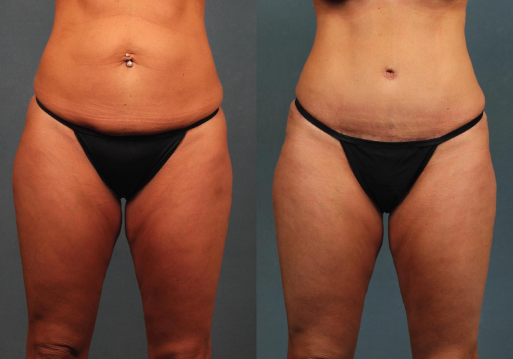 Before & After Tummy Tuck Case 269 View #1 View in Louisville, KY