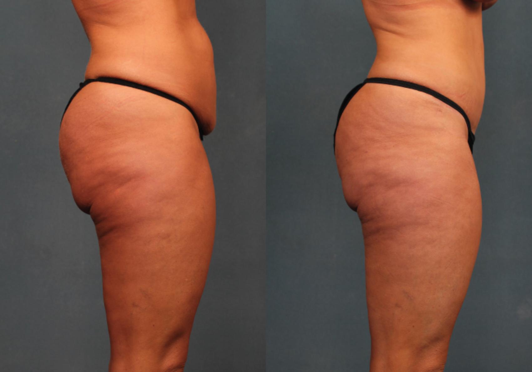 Before & After Tummy Tuck Case 269 View #2 View in Louisville, KY