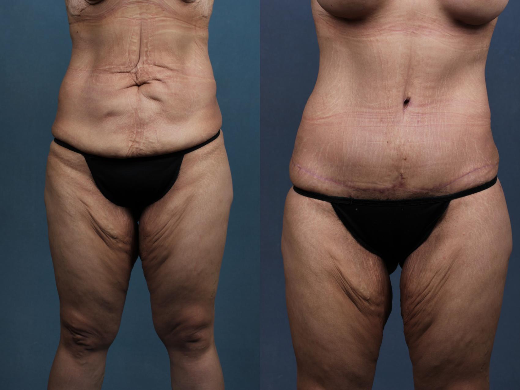 Before & After Tummy Tuck Case 565 View #1 View in Louisville & Lexington, KY