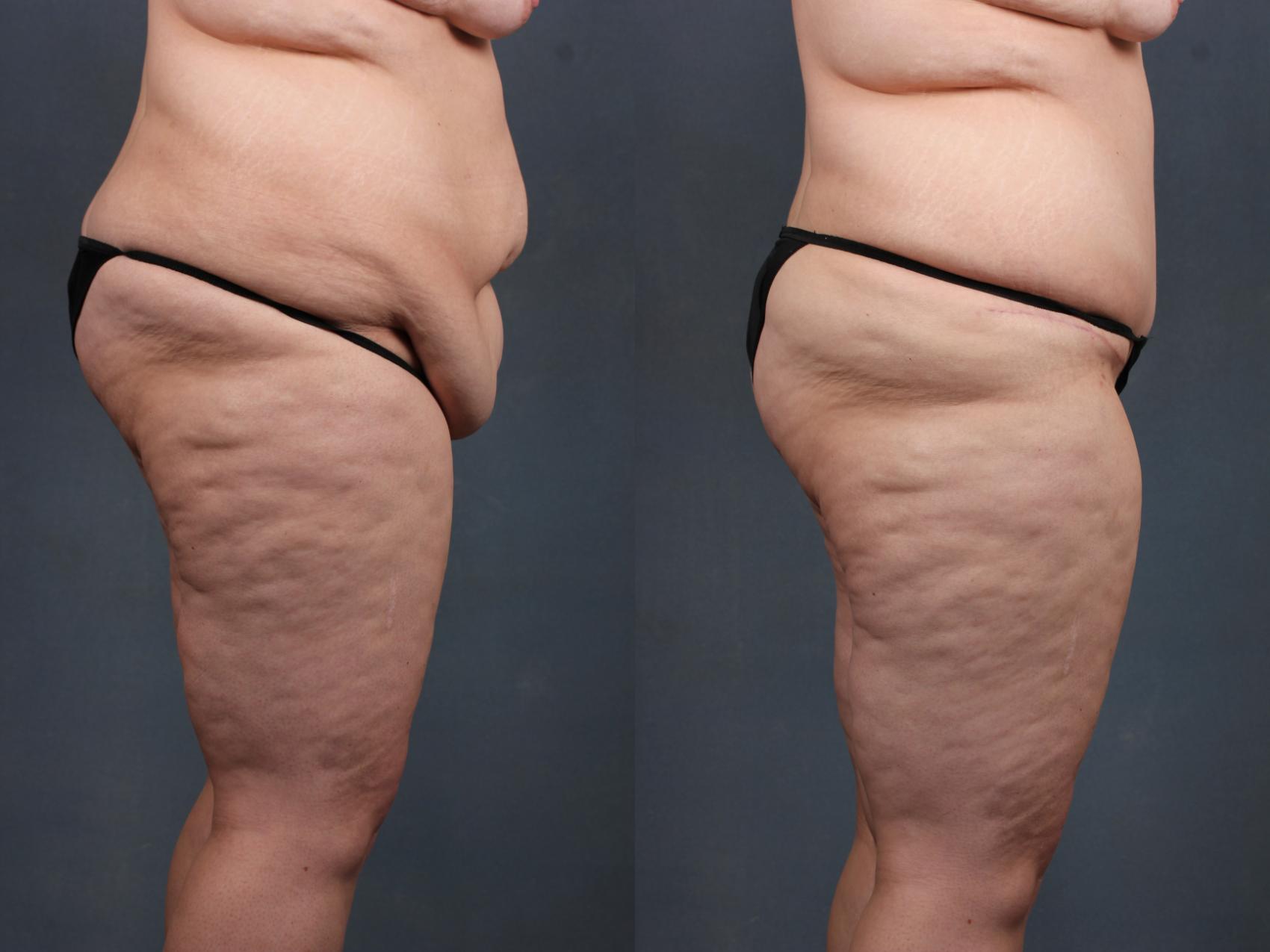 Before & After Tummy Tuck Case 566 View #2 View in Louisville & Lexington, KY
