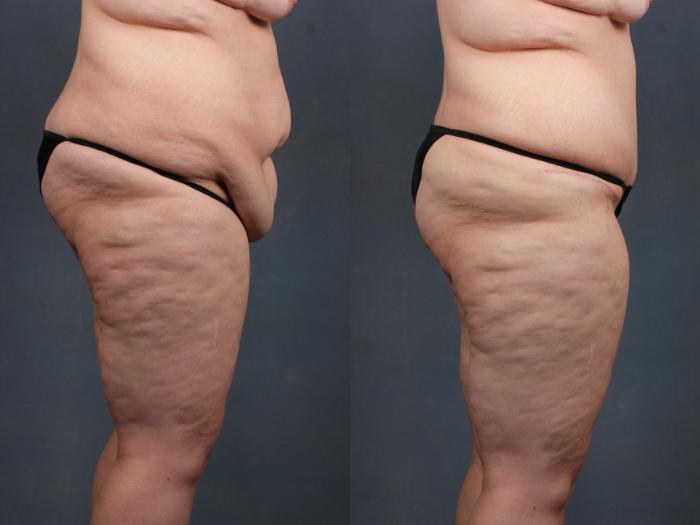 Before & After Tummy Tuck Case 566 View #2 View in Louisville & Lexington, KY