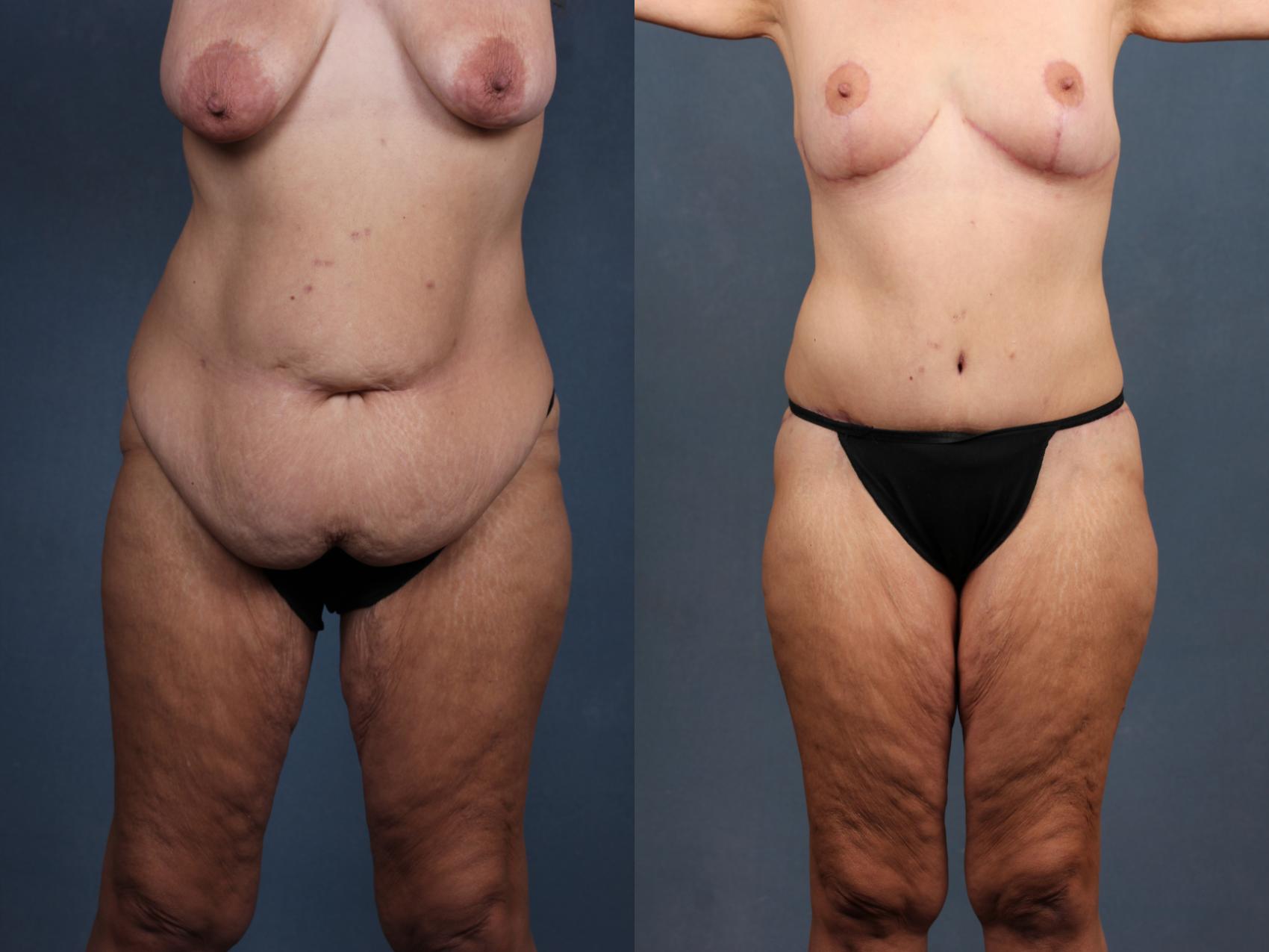 Before & After Tummy Tuck Case 567 View #1 View in Louisville, KY