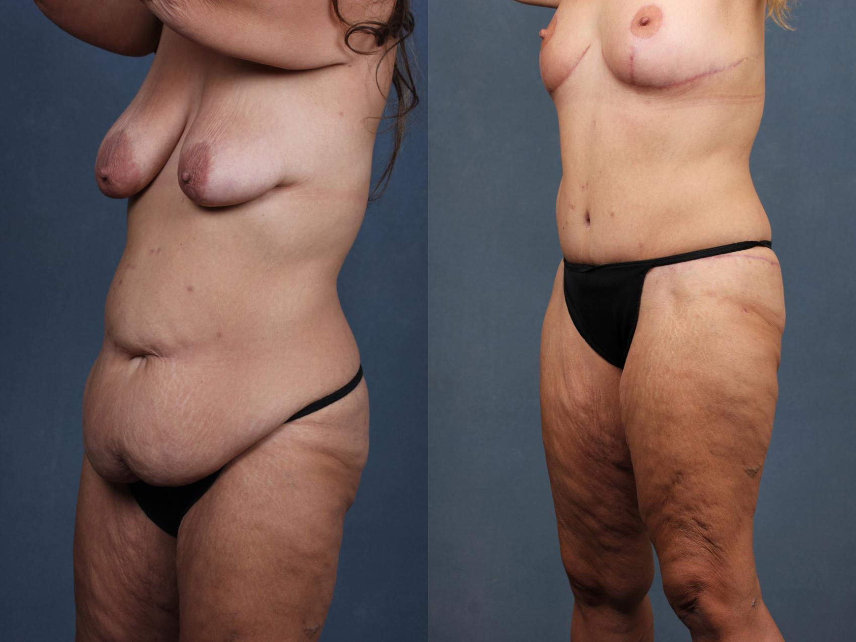 Before & After Tummy Tuck Case 567 View #2 View in Louisville, KY