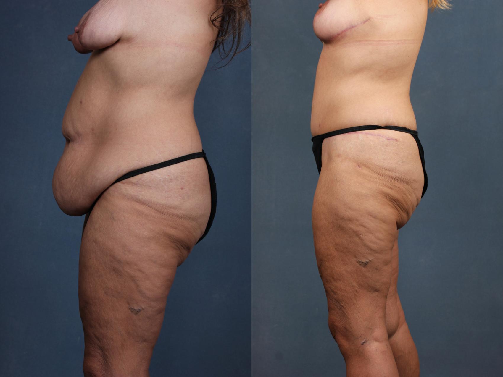 Before & After Tummy Tuck Case 567 View #3 View in Louisville & Lexington, KY