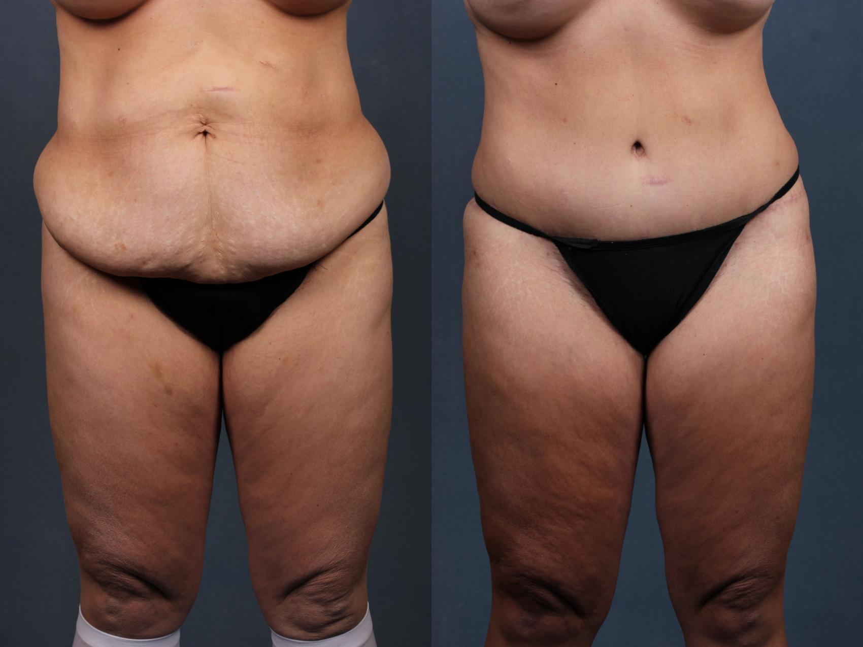 Before & After Tummy Tuck Case 568 View #1 View in Louisville & Lexington, KY