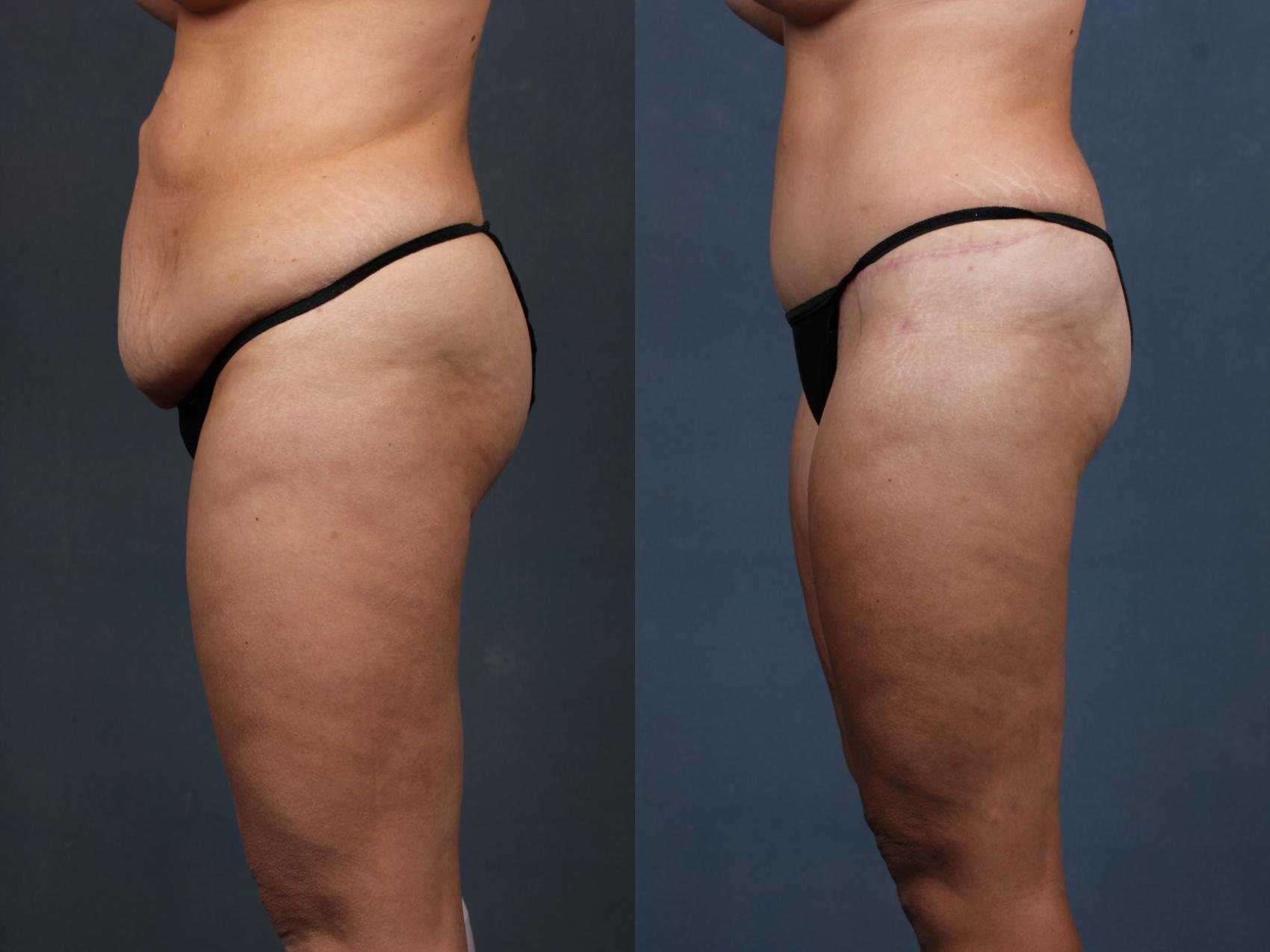 Before & After Tummy Tuck Case 568 View #2 View in Louisville & Lexington, KY