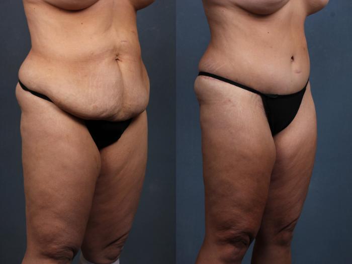 Before & After Tummy Tuck Case 568 View #3 View in Louisville & Lexington, KY