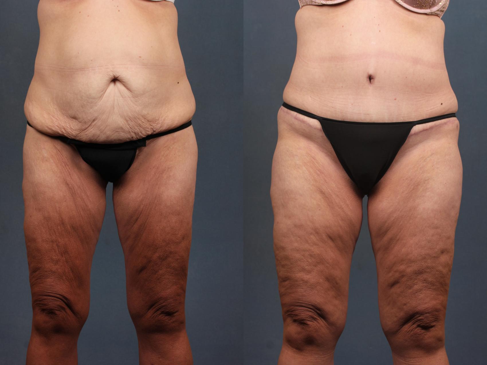 Before & After Tummy Tuck Case 569 View #1 View in Louisville, KY
