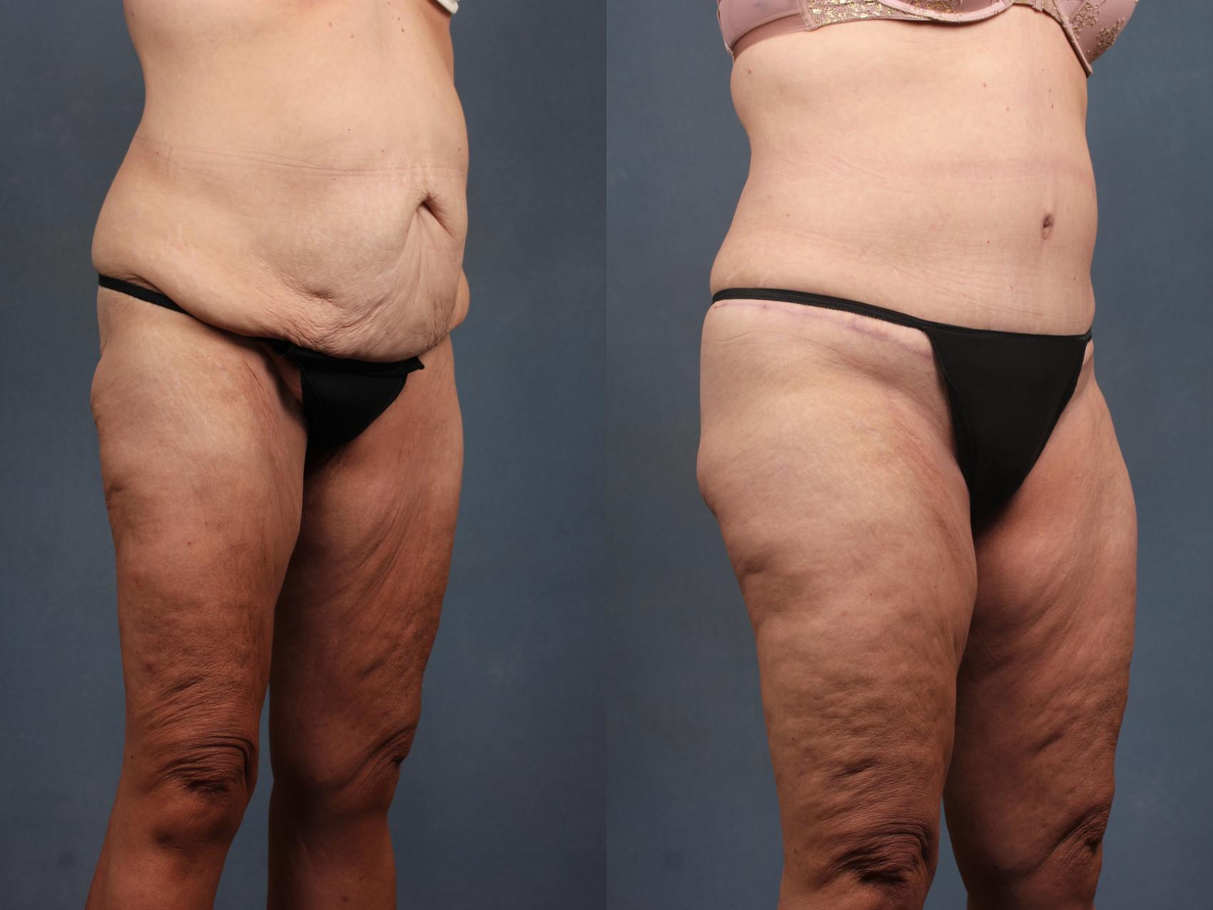 Before & After Tummy Tuck Case 569 View #3 View in Louisville & Lexington, KY