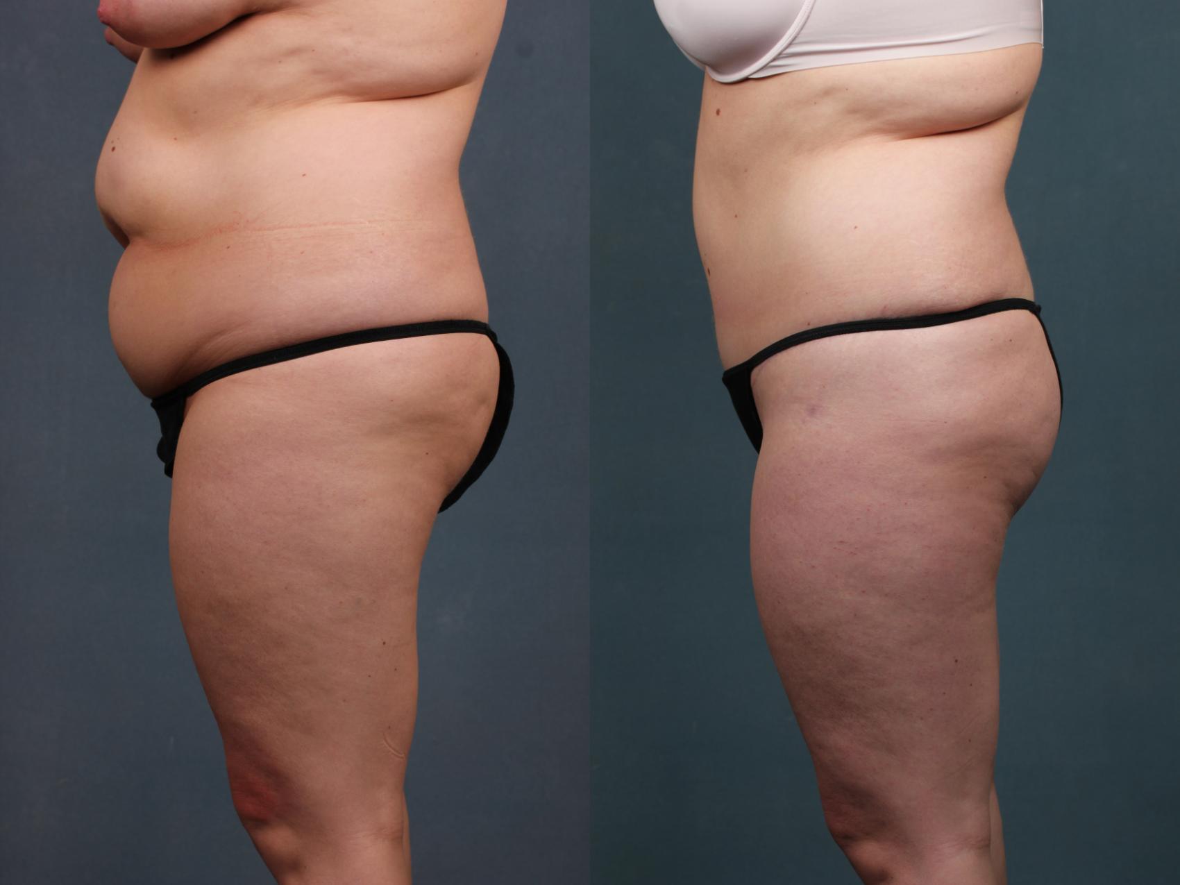 Before & After Tummy Tuck Case 570 View #1 View in Louisville & Lexington, KY