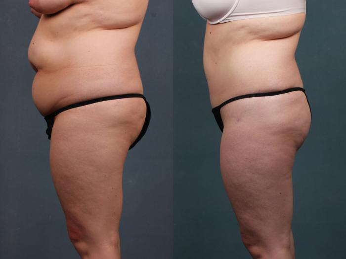 Before & After Tummy Tuck Case 570 View #1 View in Louisville, KY