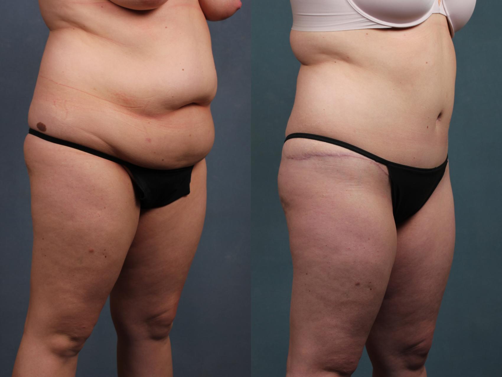 Before & After Tummy Tuck Case 570 View #2 View in Louisville & Lexington, KY