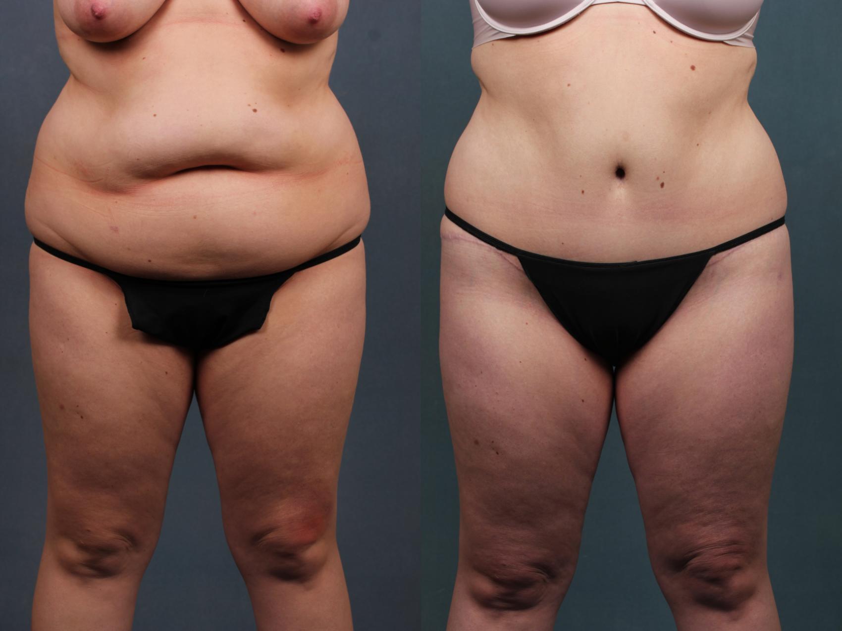 Before & After Tummy Tuck Case 570 View #3 View in Louisville & Lexington, KY