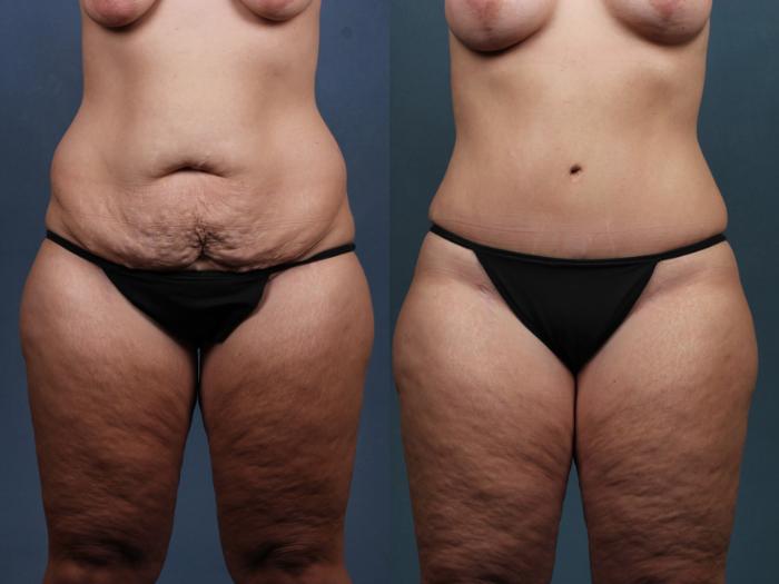Before & After Tummy Tuck Case 572 View #1 View in Louisville & Lexington, KY