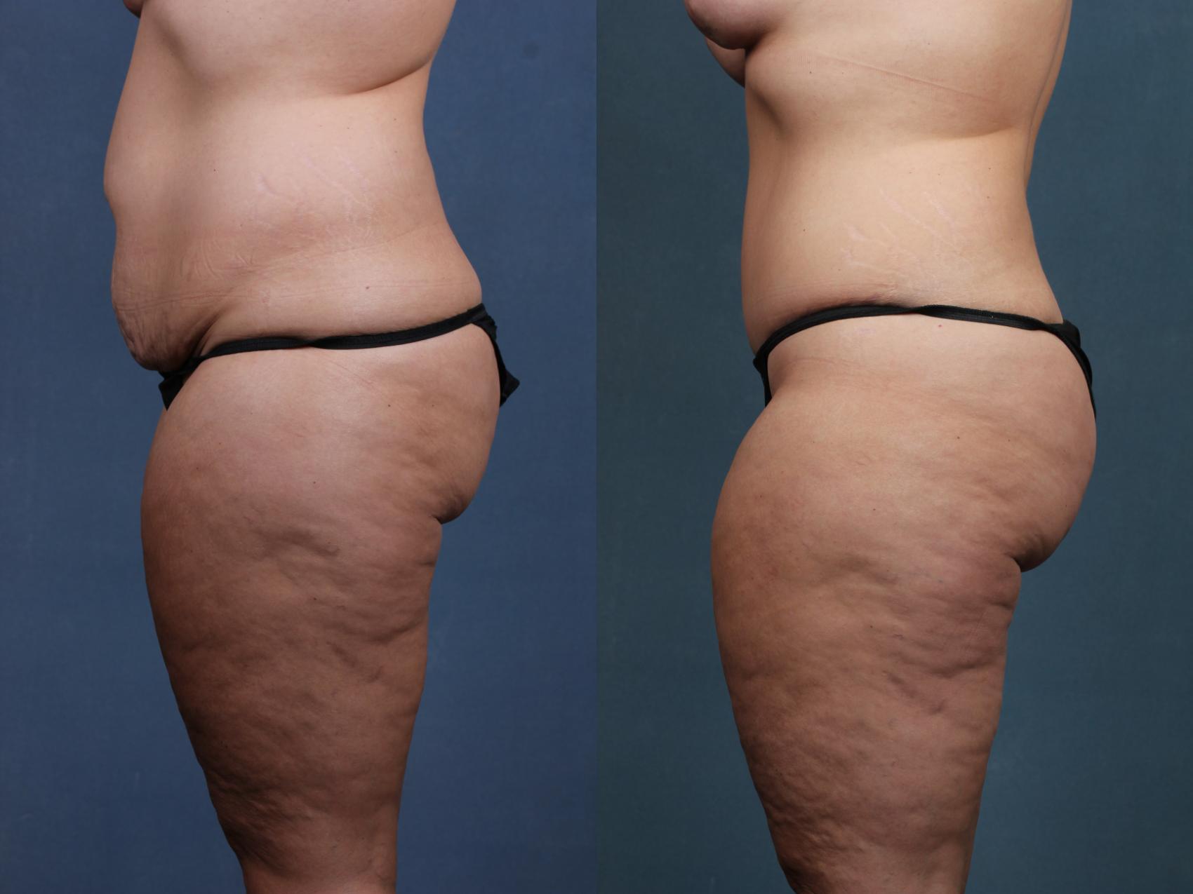 Before & After Tummy Tuck Case 572 View #2 View in Louisville & Lexington, KY