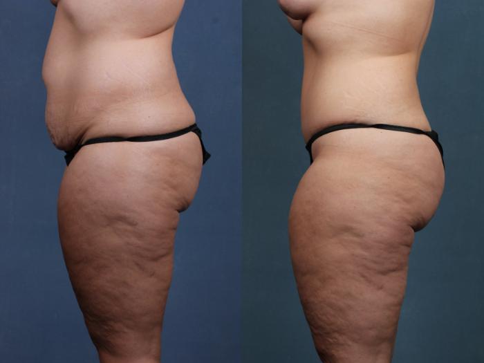 Tummy Tuck Case 572 Before & After View #2 | Louisville, KY | CaloSpa® Rejuvenation Center